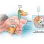 بیوپسی کلیه و تشخیص بیماری های کلیوی